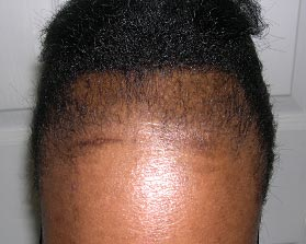 Como evitar la alopecia por traccion